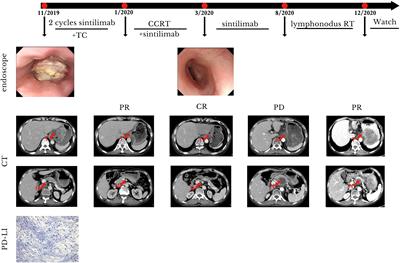 “Sandwich Therapy”—Immunotherapy Plus Concurrent Chemoradiotherapy for Advanced Esophagogastric Junction Carcinoma: Report of Two Cases and Literature Review